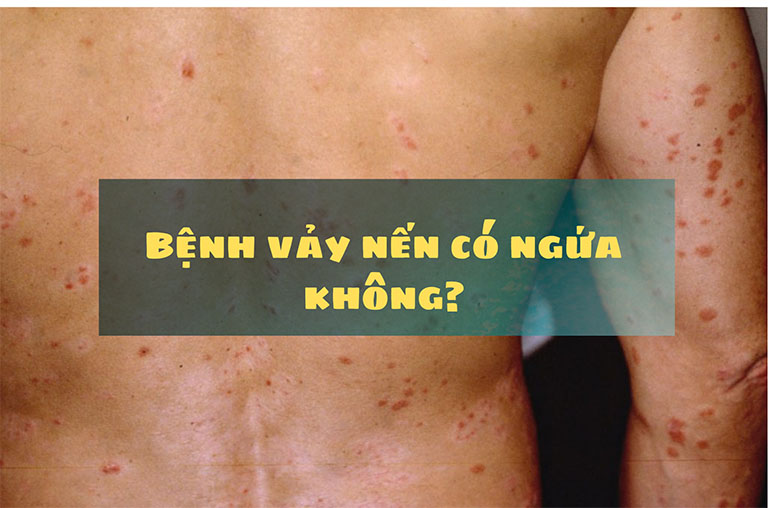 Bệnh vảy nến có ngứa không?