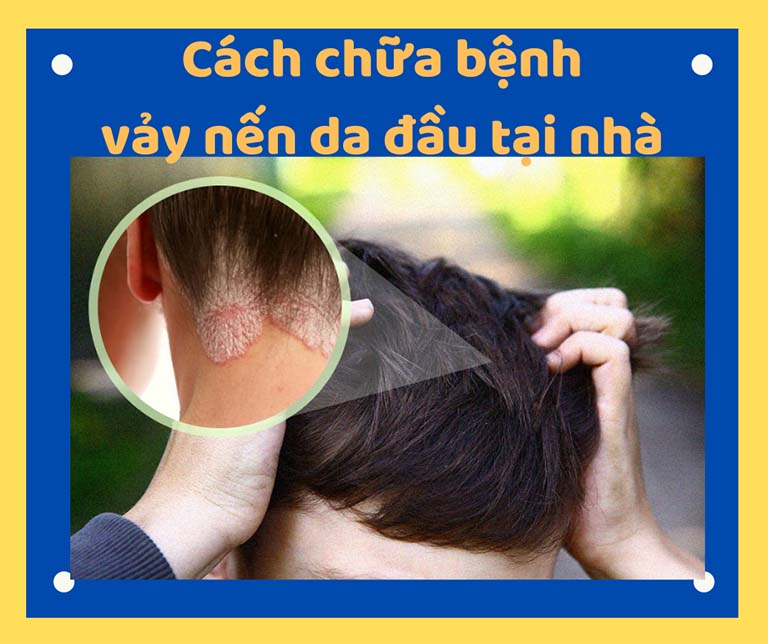 cách chữa bệnh vảy nến da đầu