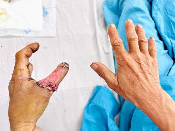 Bàn tay trái của bệnh nhân Phạm N. P được các bác sĩ khoa Ngoại chấn thương - chỉnh hình Bệnh viện Đà Nẵng cái hóa thành công sau khi bị đứt rời ngốn số 1 và ngốn số 3