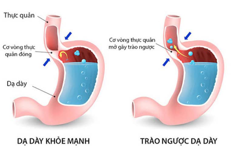 cảm giác nghẹn ở thực quản