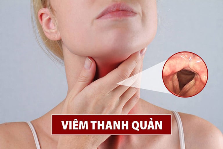 Cổ họng đau rát khi nuốt