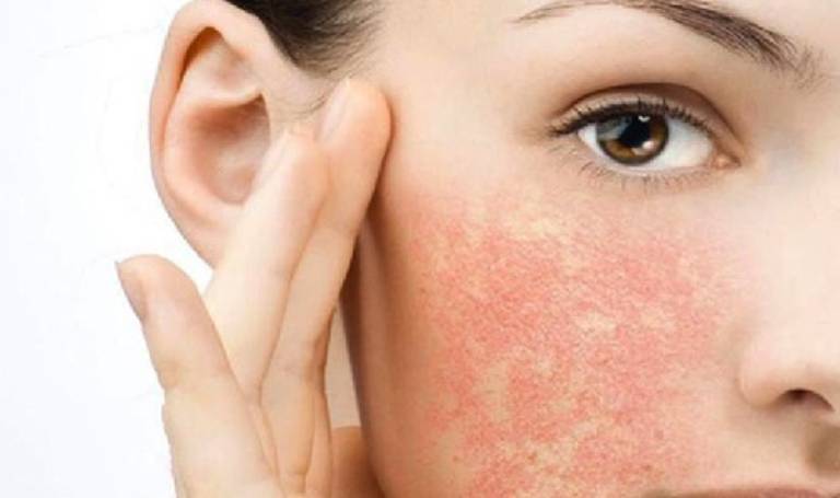Khi bị dị ứng mỹ phẩm, bạn cần chăm sóc da mặt cẩn thận để tránh làm tình trạng mụn trên da mặt thêm nghiêm trọng hơn