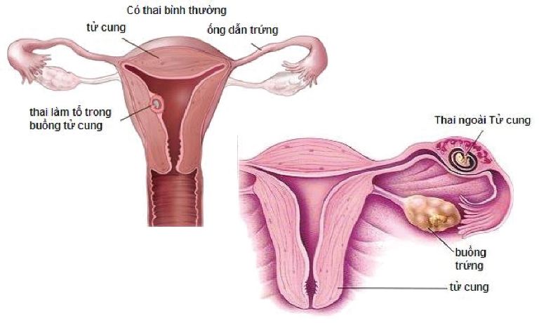 đau bụng dưới khi mang thai tháng đầu