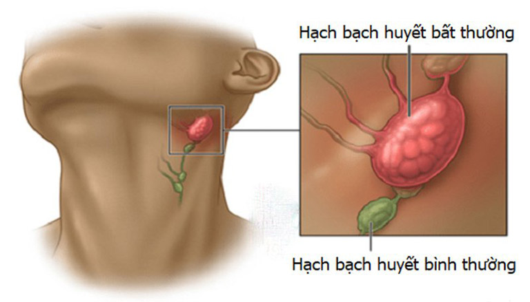 Đau họng nổi hạch dưới hàm