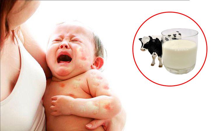 Dị ứng đạm sữa bò ở trẻ