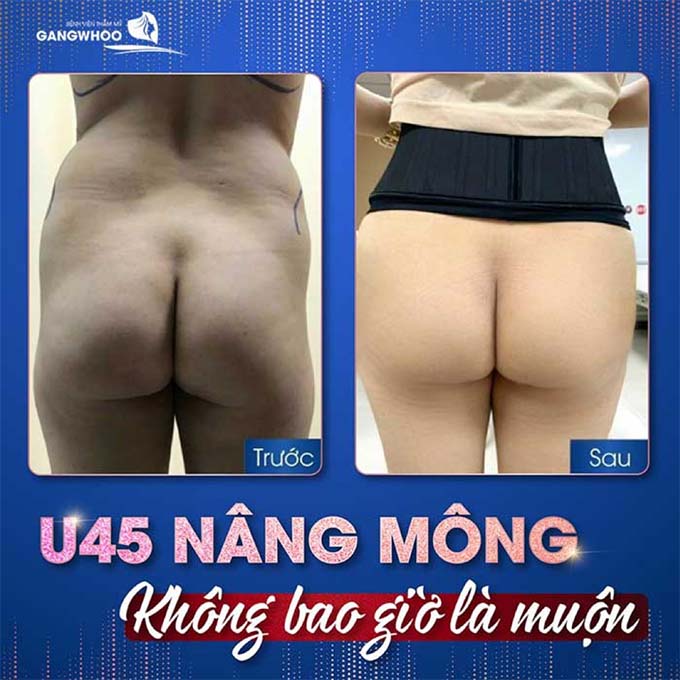 Nâng mông uy tín tại TPHCM, Bệnh viện thẩm mỹ Gangwhoo