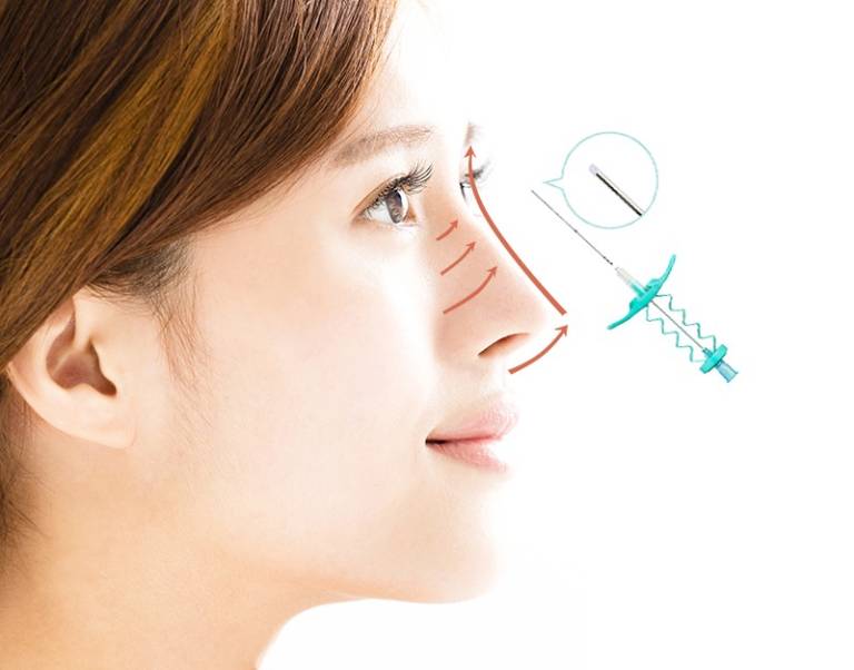 Nâng mũi chỉ: Phương pháp nâng mũi tiềm ẩn nhiều nguy hiểm