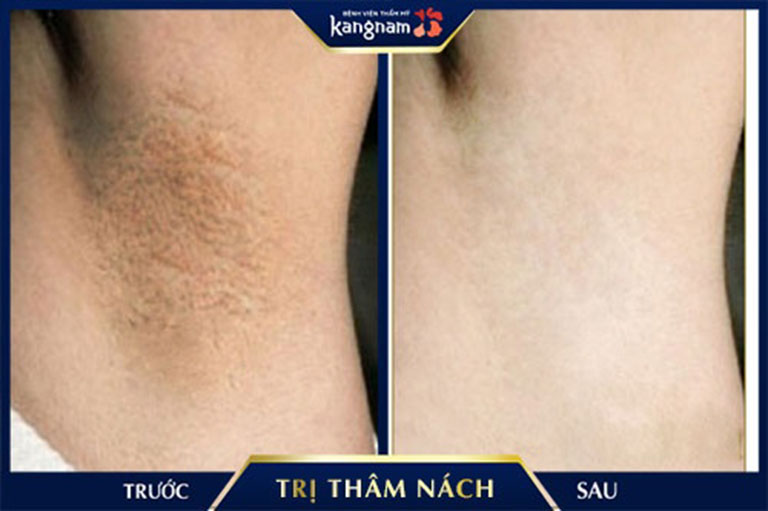 trị thâm nách mông bẹn ở tphcm