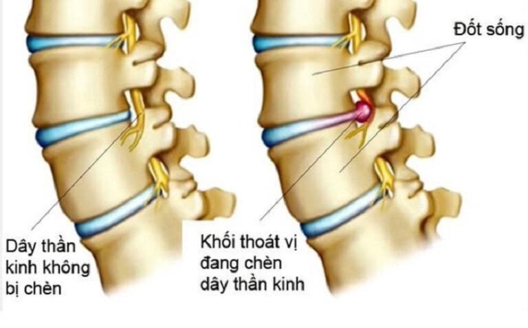 Thoát vị đĩa đệm chèn dây thần kinh là gì?