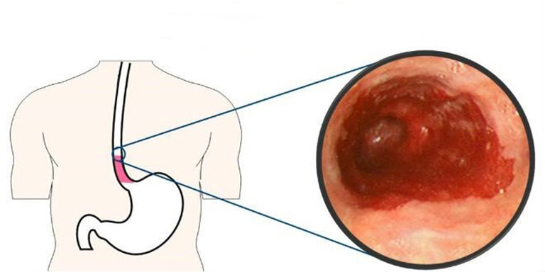 trào ngược dịch mật