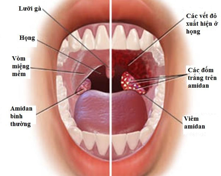  viêm amidan hốc mủ bã đậu