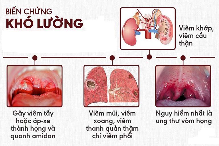 Viêm họng hạt có mủ