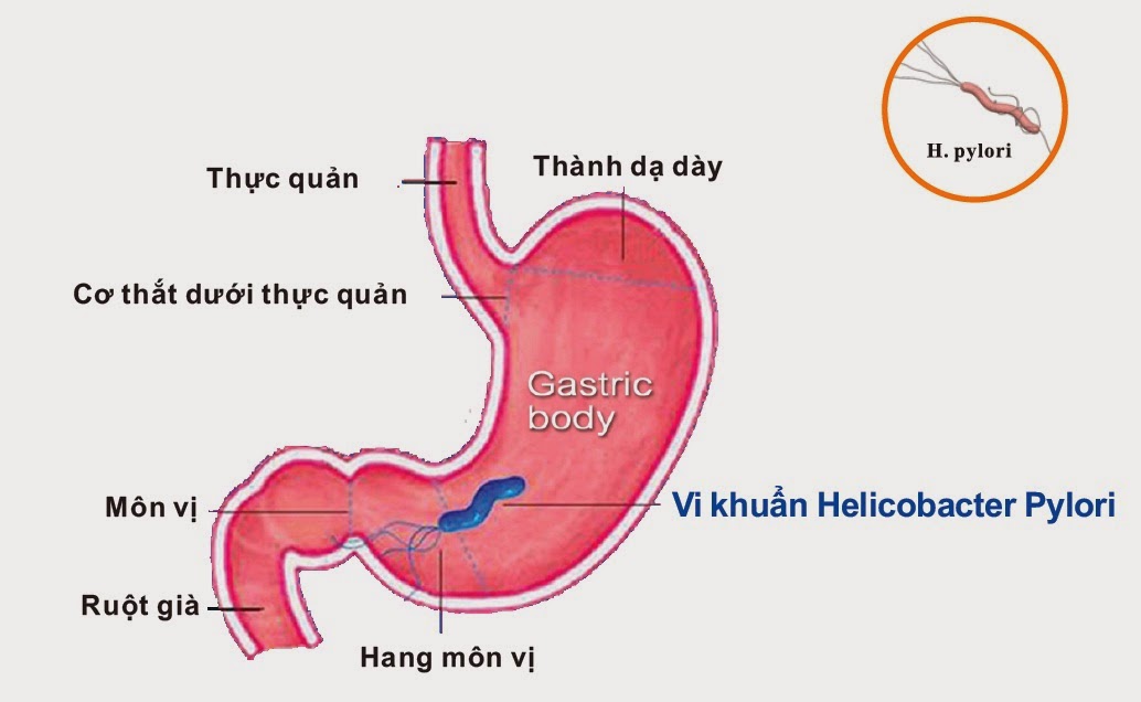 Viêm xung huyết hang vị có vi khuẩn hp