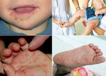 Bộ Y tế khuyến cáo biện pháp phòng chống bệnh tay chân miệng