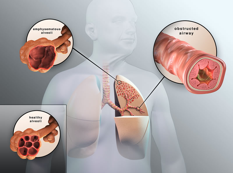 [Bệnh Án] Bệnh Án Đợt Cấp COPD Mức Độ Nặng