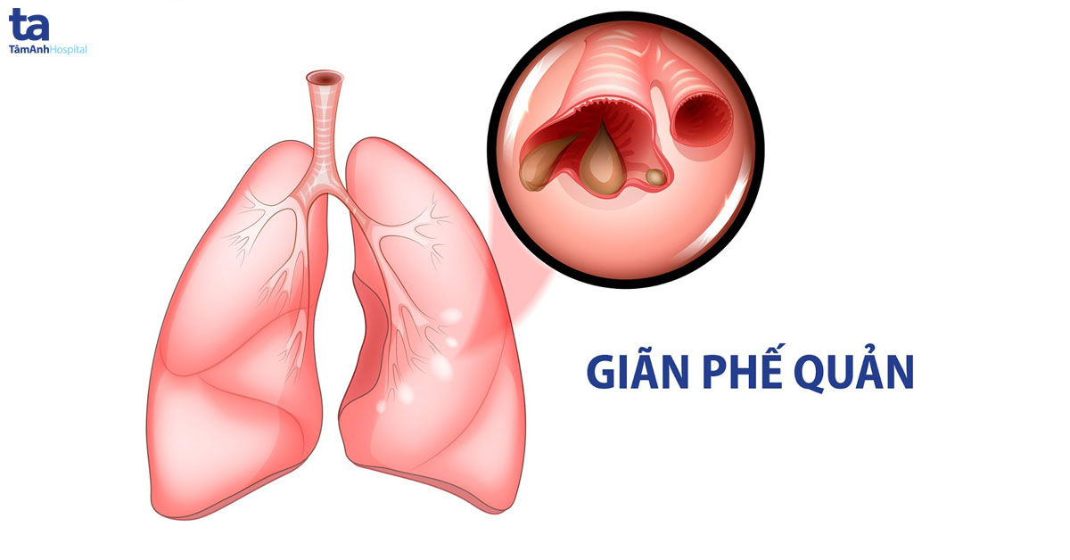 [Bệnh Án] Bệnh Án Giãn Phế Quản