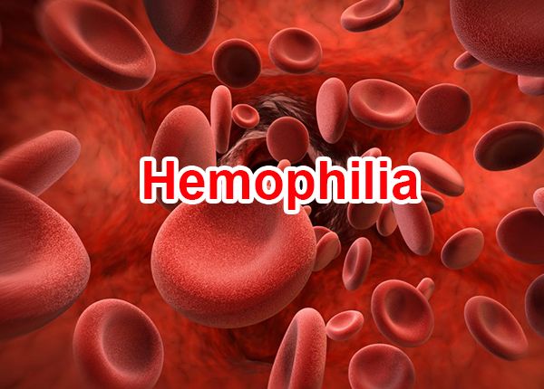[Bệnh Án] Bệnh Án Nhi Khoa: Hemophilia A TD Xuất Huyết Não