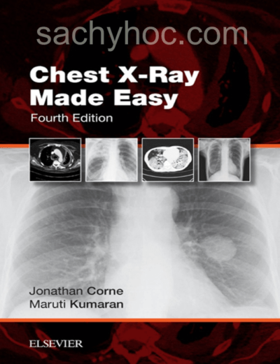 Hướng dẫn đọc & Giải thích phim X-Quang phổi dễ dàng, phiên bản 4