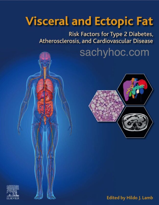 Mỡ tạng và lạc chỗ: Các yếu tố nguy cơ cho bệnh tiểu đường típ 2, xơ cứng động mạch và bệnh tim mạch, ấn bản 2022