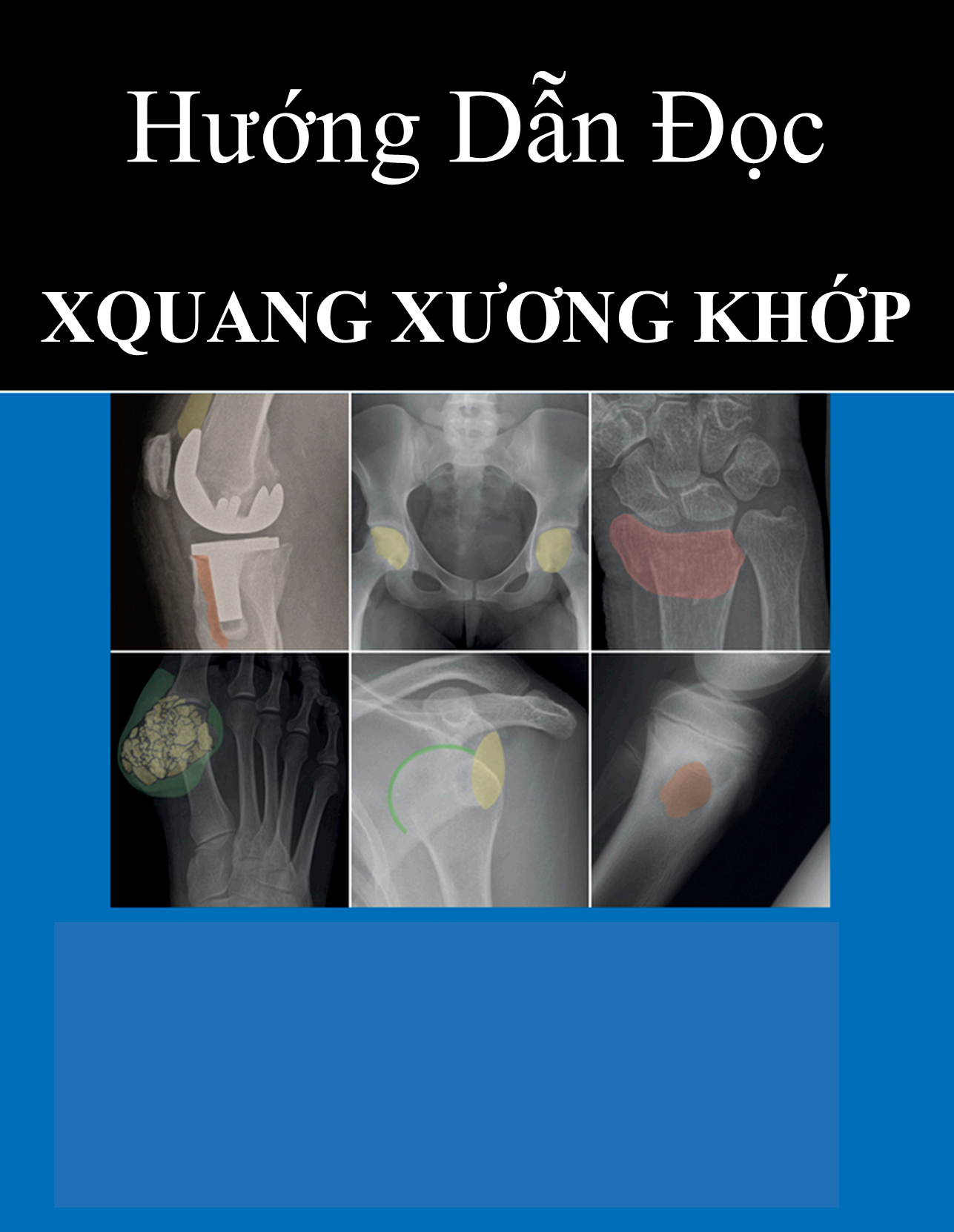 [Tài Liệu Dịch] Hướng Dẫn Đọc X-Quang Xương Khớp