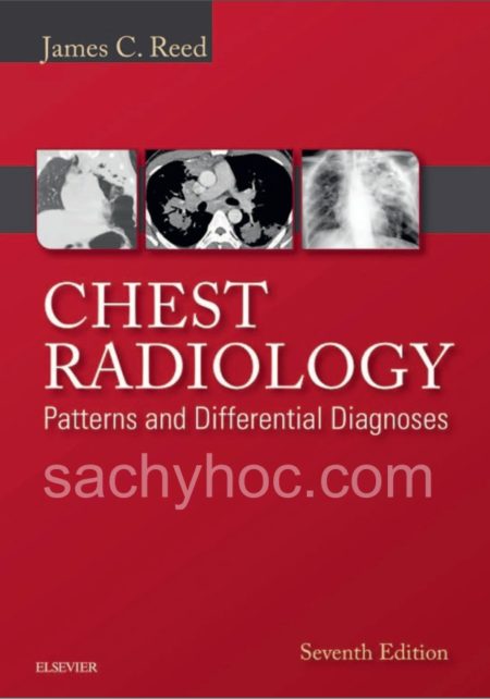 X quang ngực: Các mô hình và chẩn đoán phân biệt, 7e